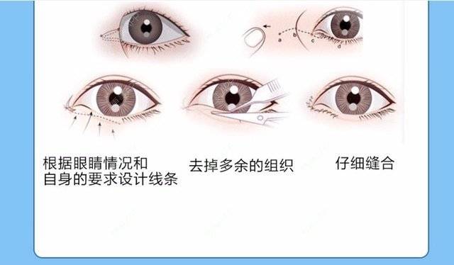 更美 - 邓泽臣 医生的全切双眼皮经验 | 全切双眼皮