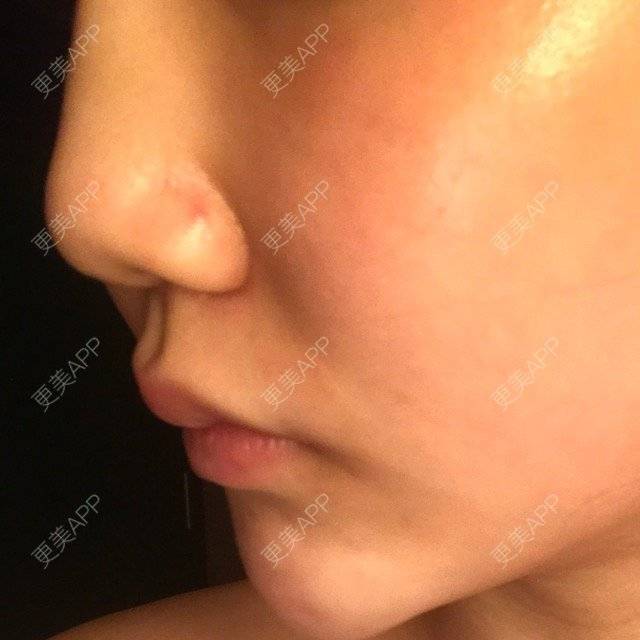 更美 - Sqw的经验 | 玻尿酸鼻基底 | 鼻基底抬高 | 鼻基底改善 | 大连
