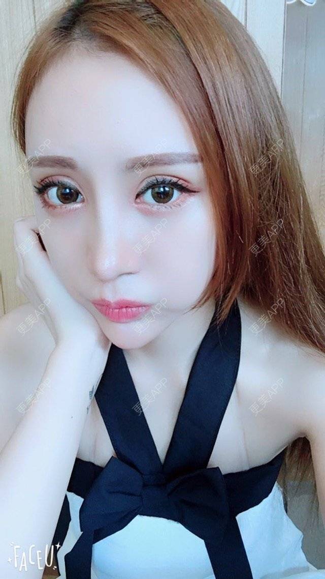 更美 - 小主播网红一枚😊的鼻部多项经验 | 广州 | 双眼皮微创 | 眼部整形 | 鼻部多项