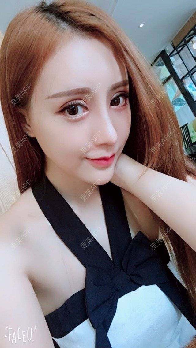 更美 - 小主播网红一枚😊的鼻部多项经验 | 广州 | 双眼皮微创 | 眼部整形 | 鼻部多项