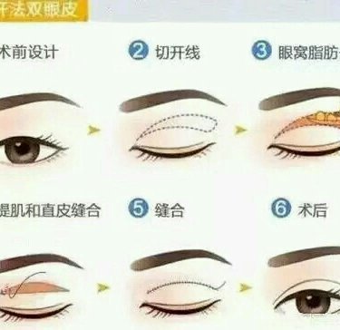 双眼皮