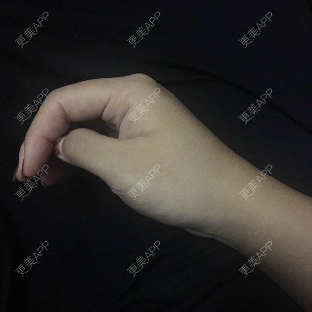 更美 - ROU_rou的注射美白经验 | 注射美白 | 土豪溶脂针 | 清远