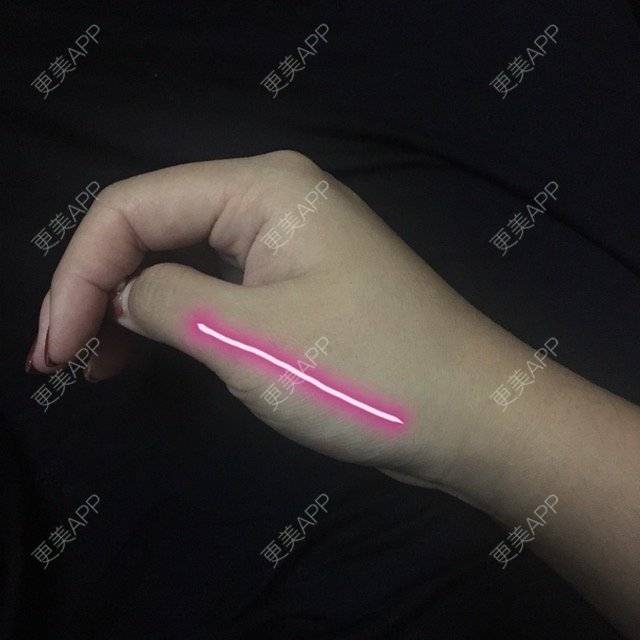 更美 - ROU_rou的注射美白经验 | 注射美白 | 土豪溶脂针 | 清远