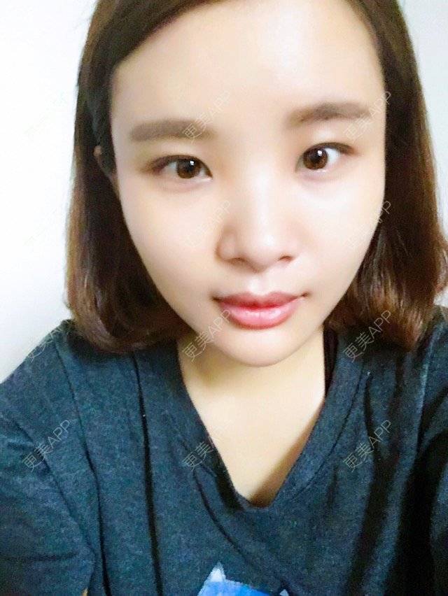 更美 - 照相机、的经验 | 注射美容 | 重庆 | 自体脂肪丰全面部 | 吸脂手术