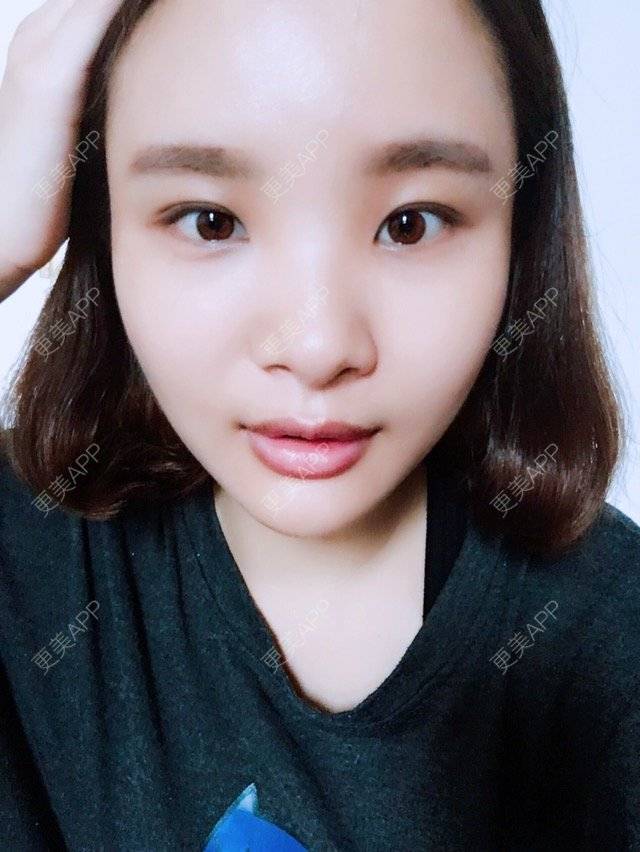 更美 - 照相机、的经验 | 注射美容 | 重庆 | 自体脂肪丰全面部 | 吸脂手术