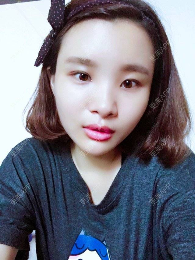 更美 - 照相机、的经验 | 注射美容 | 重庆 | 自体脂肪丰全面部 | 吸脂手术