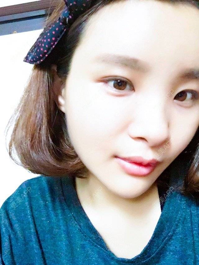 更美 - 照相机、的经验 | 注射美容 | 重庆 | 自体脂肪丰全面部 | 吸脂手术