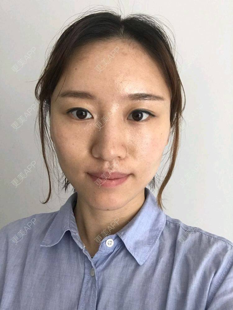 更美 - 饭碗的彼岸的埋线提升经验 | 埋线提升 | 线雕v脸成型 | 全面部提升 | 深圳