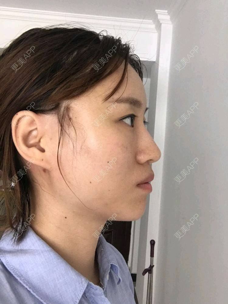 更美 - 饭碗的彼岸的埋线提升经验 | 埋线提升 | 线雕v脸成型 | 全面部提升 | 深圳