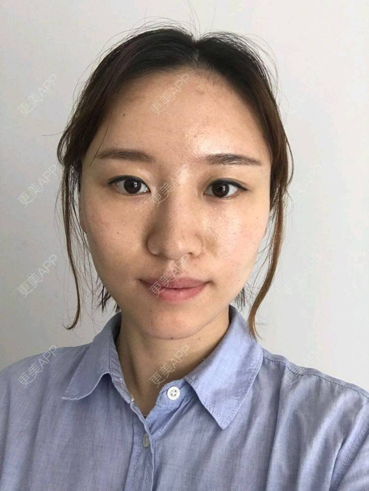 更美 - 饭碗的彼岸的埋线提升经验 | 埋线提升 | 线雕v脸成型 | 全面部提升 | 深圳