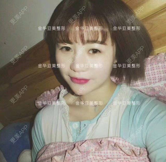 更美 - 邓泽臣 医生的全切双眼皮经验 | 全切双眼皮