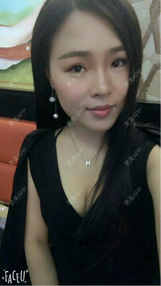 更美 - 只有七秒的记忆的自体脂肪丰面颊经验 | 自体脂肪面部填充 | 面部 | 自体脂肪丰面颊 | 面部改善 | 成都