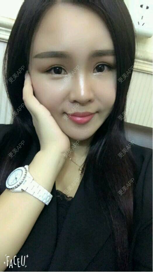 更美 - 只有七秒的记忆的自体脂肪丰面颊经验 | 自体脂肪面部填充 | 面部 | 自体脂肪丰面颊 | 面部改善 | 成都