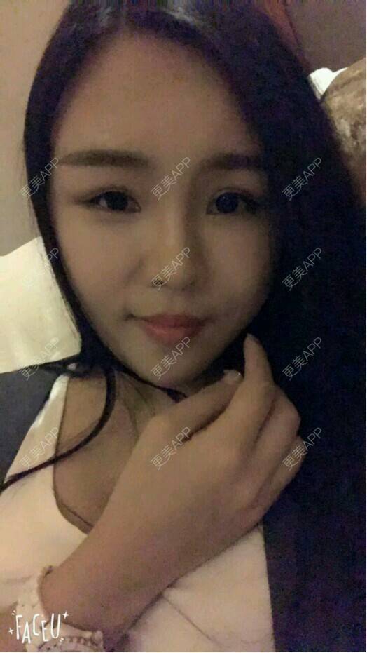 更美 - 只有七秒的记忆的自体脂肪丰面颊经验 | 自体脂肪面部填充 | 面部 | 自体脂肪丰面颊 | 面部改善 | 成都