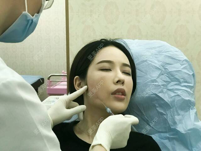更美 - 网络主播肖肖😄的玻尿酸面颊经验 | 玻尿酸填充脸部 | 玻尿酸面颊 | 玻尿酸 | 广州