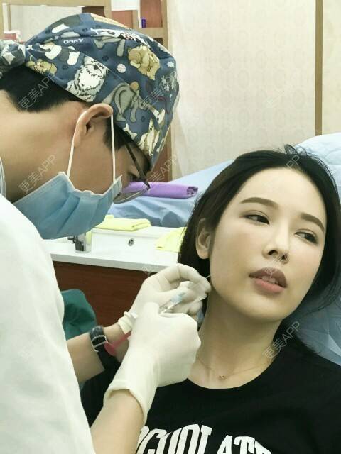 更美 - 网络主播肖肖😄的玻尿酸面颊经验 | 玻尿酸填充脸部 | 玻尿酸面颊 | 玻尿酸 | 广州