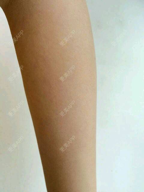 更美 - 芳华依旧的手臂脱毛经验 | 兰州 | 手臂脱毛