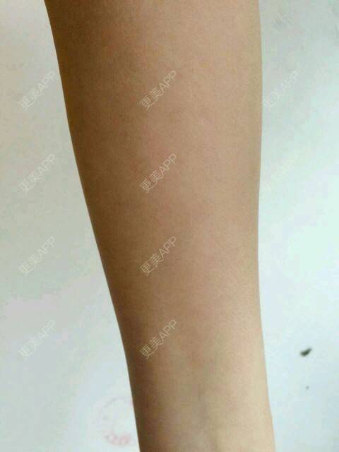 更美 - 芳华依旧的手臂脱毛经验 | 兰州 | 手臂脱毛