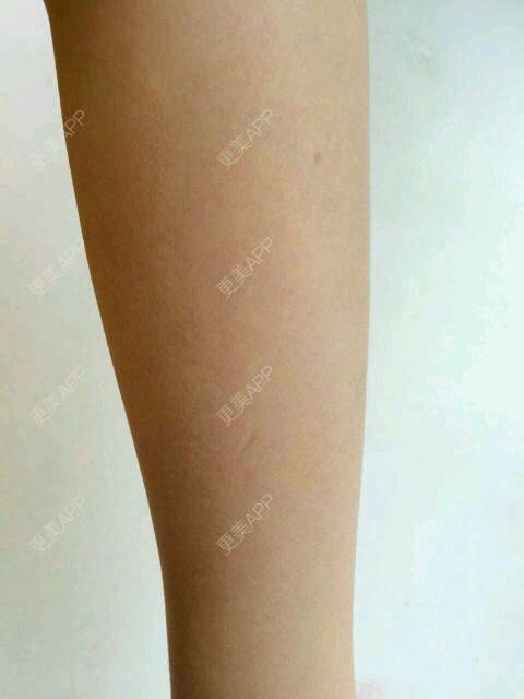 更美 - 芳华依旧的手臂脱毛经验 | 兰州 | 手臂脱毛