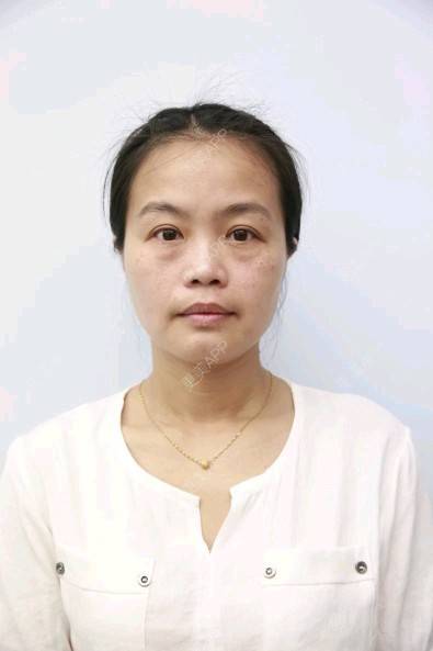 更美 - 木兰香kiss的激光点痣经验 | 去痣 | 重庆 | 激光点痣 | 皮肤
