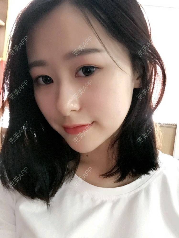 更美 - 腿短猫不吃鱼的玻尿酸下巴经验 | 玻尿酸下巴 | 武汉