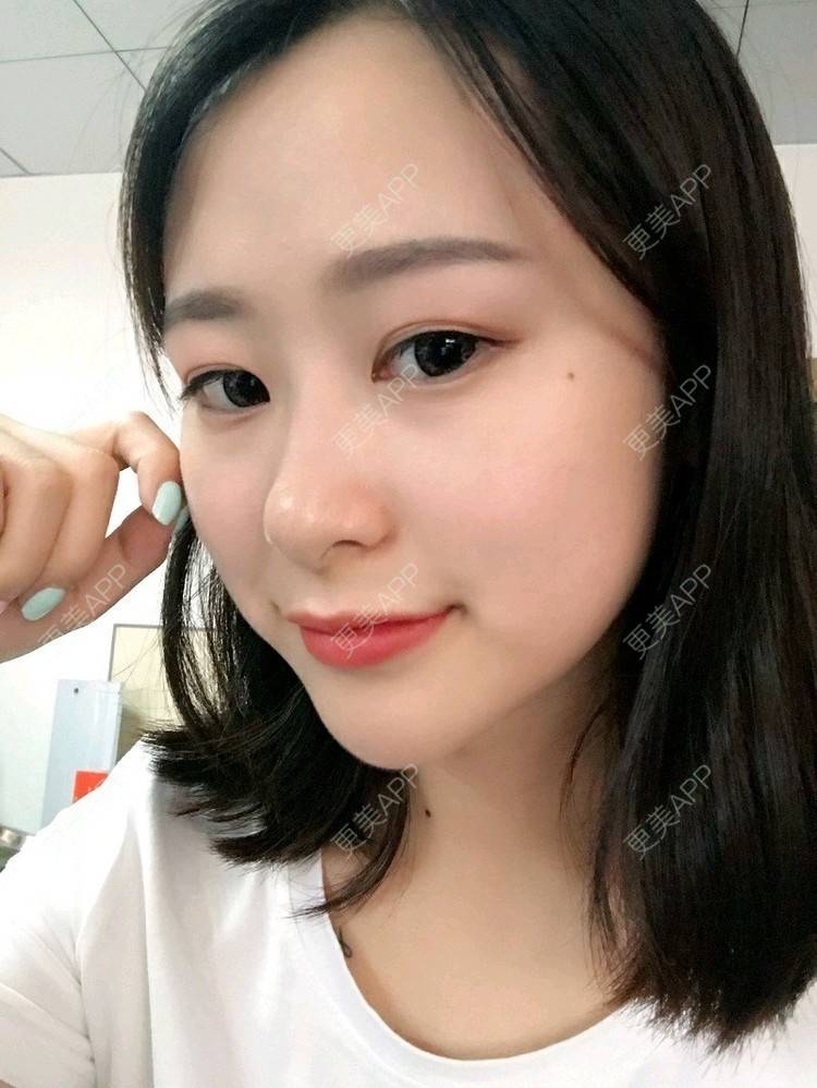 更美 - 腿短猫不吃鱼的玻尿酸下巴经验 | 玻尿酸下巴 | 武汉
