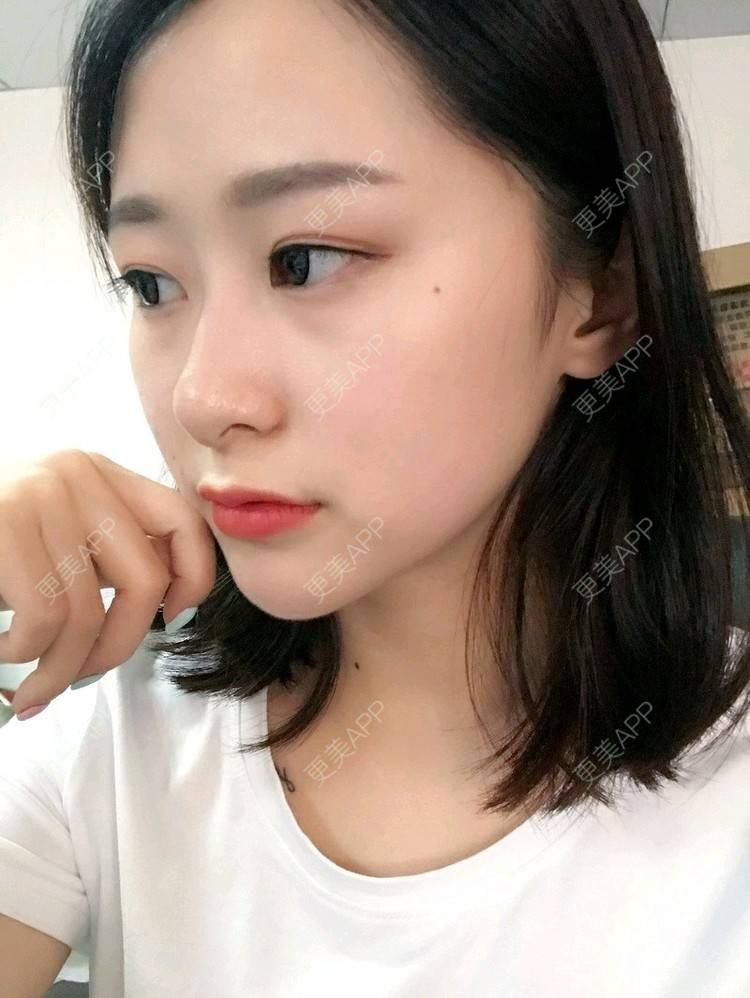 更美 - 腿短猫不吃鱼的玻尿酸下巴经验 | 玻尿酸下巴 | 武汉