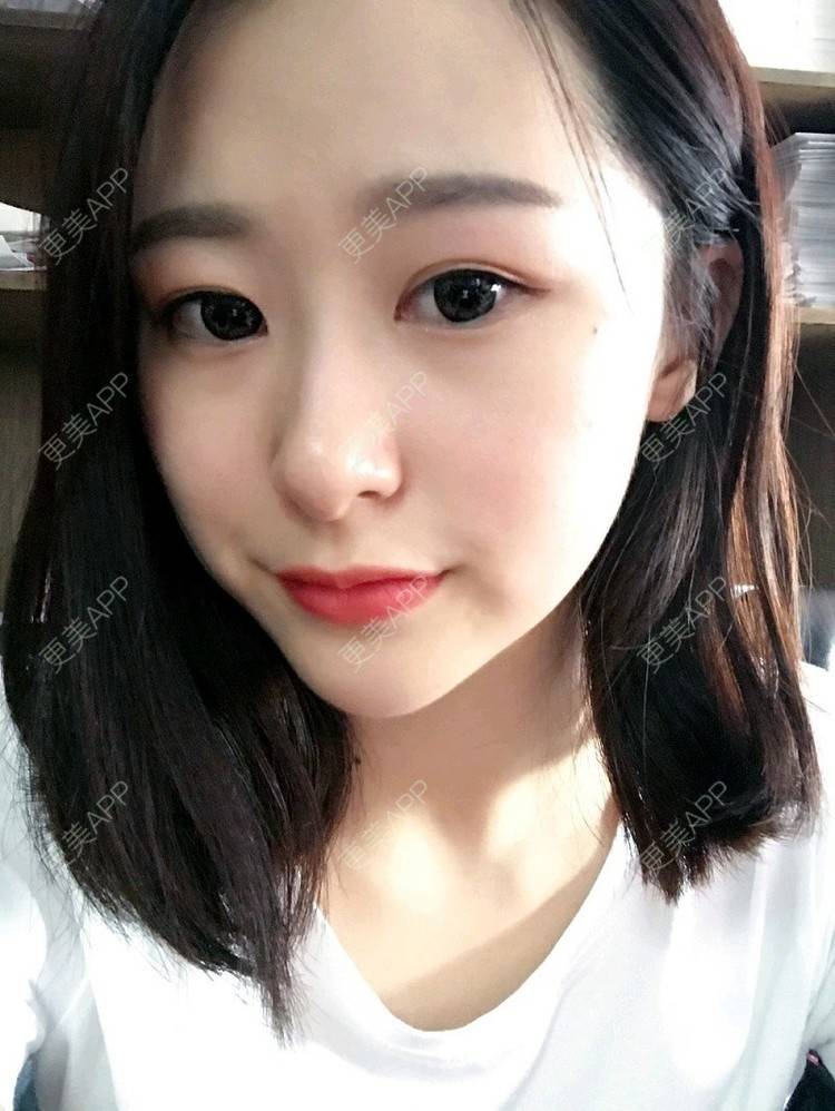更美 - 腿短猫不吃鱼的玻尿酸下巴经验 | 玻尿酸下巴 | 武汉