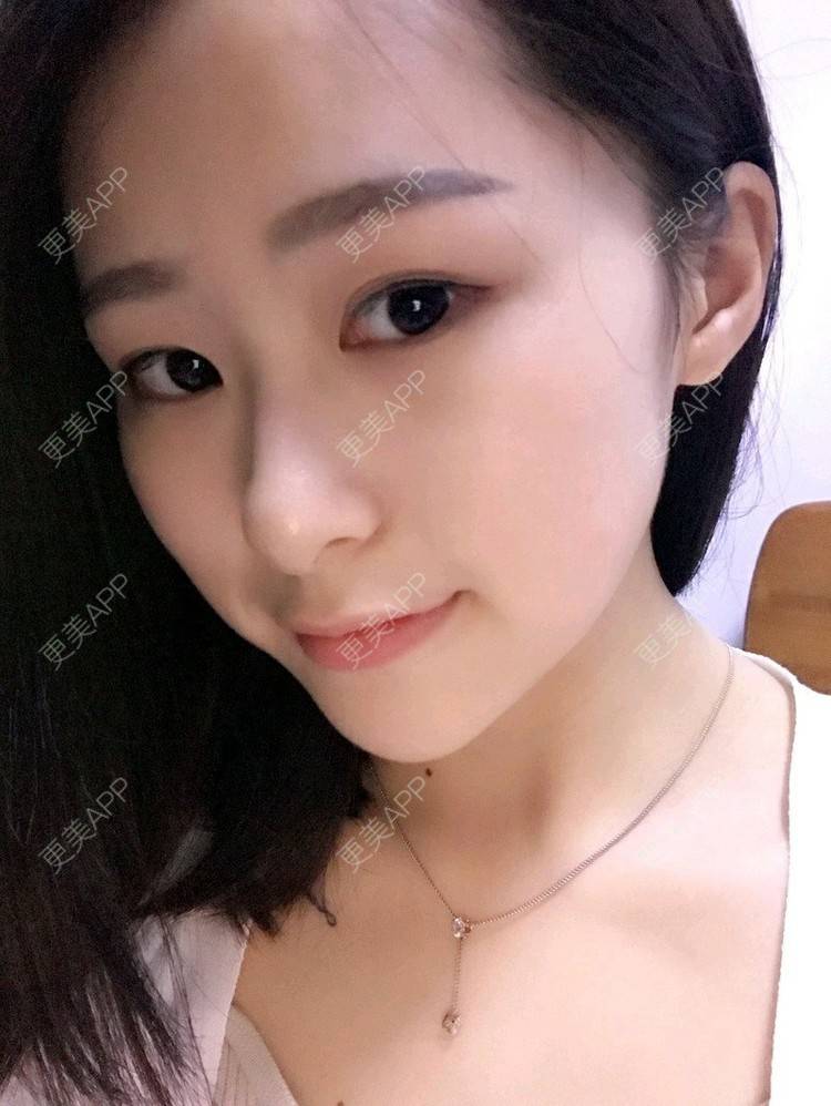 更美 - 腿短猫不吃鱼的玻尿酸下巴经验 | 玻尿酸下巴 | 武汉