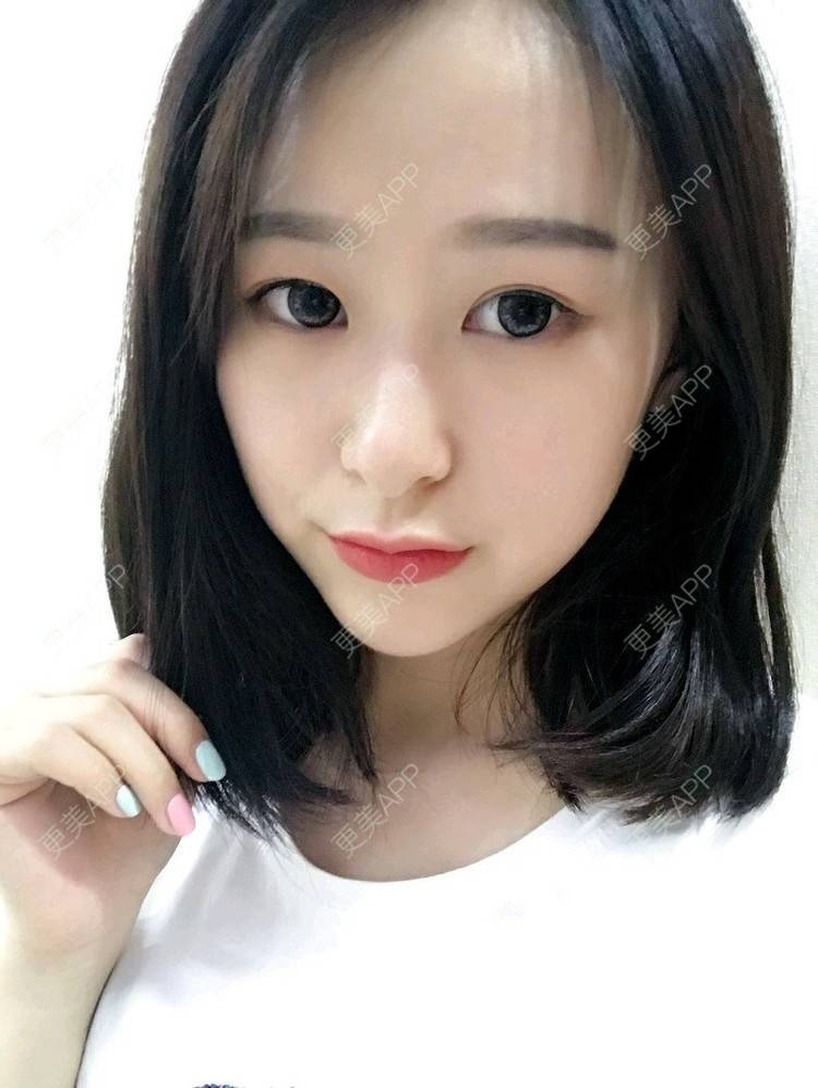 更美 - 腿短猫不吃鱼的玻尿酸下巴经验 | 玻尿酸下巴 | 武汉