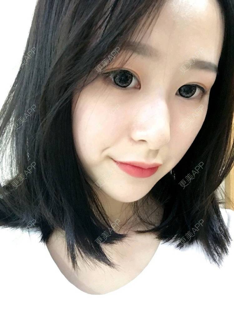 更美 - 腿短猫不吃鱼的玻尿酸下巴经验 | 玻尿酸下巴 | 武汉