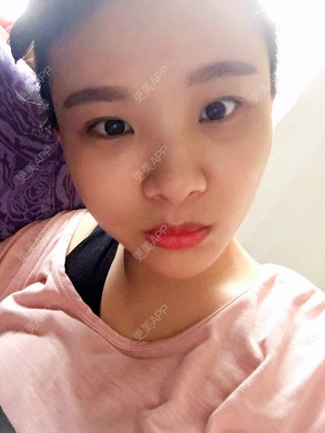 更美 - 照相机、的经验 | 注射美容 | 重庆 | 自体脂肪丰全面部 | 吸脂手术