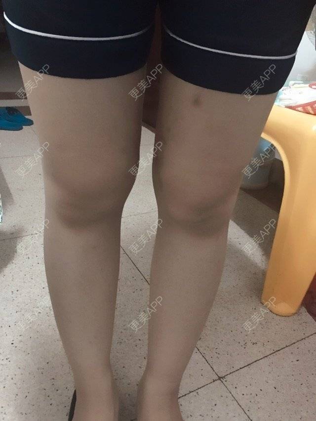 更美 - 照相机、的经验 | 注射美容 | 重庆 | 自体脂肪丰全面部 | 吸脂手术