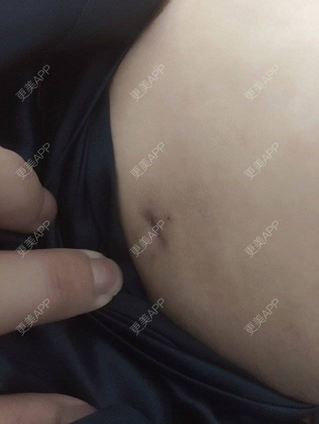 更美 - 照相机、的经验 | 注射美容 | 重庆 | 自体脂肪丰全面部 | 吸脂手术