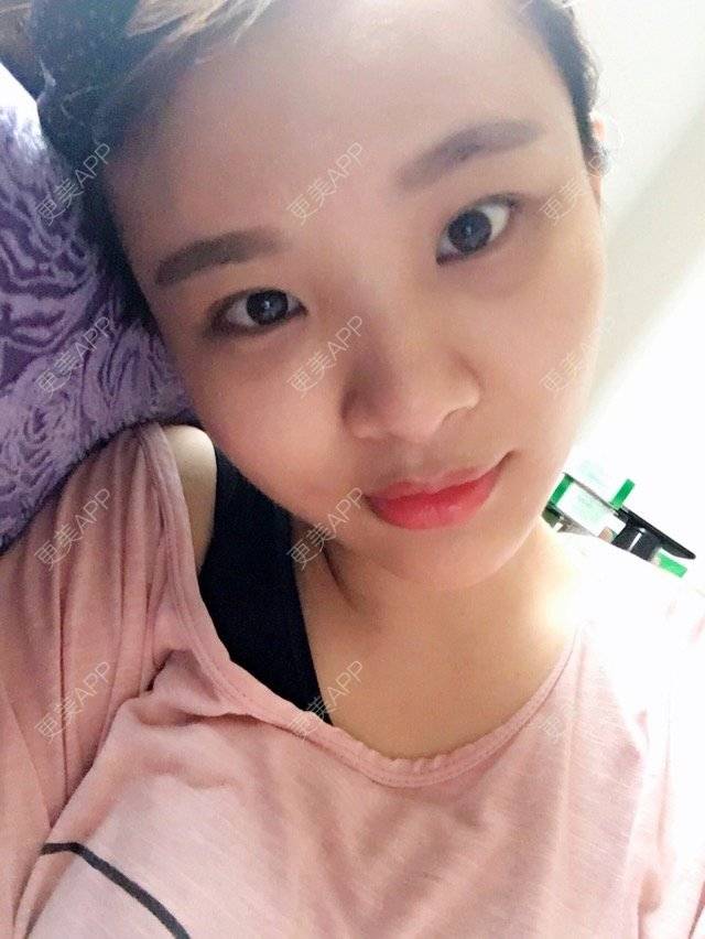 更美 - 照相机、的经验 | 注射美容 | 重庆 | 自体脂肪丰全面部 | 吸脂手术