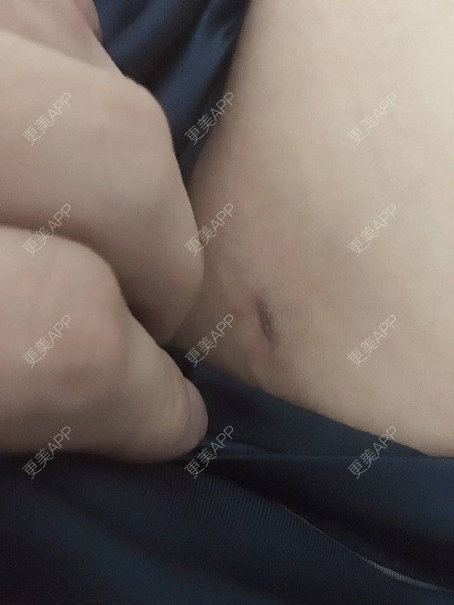 更美 - 照相机、的经验 | 注射美容 | 重庆 | 自体脂肪丰全面部 | 吸脂手术