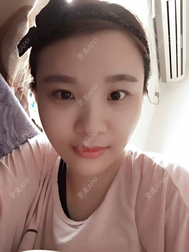 更美 - 照相机、的经验 | 注射美容 | 重庆 | 自体脂肪丰全面部 | 吸脂手术
