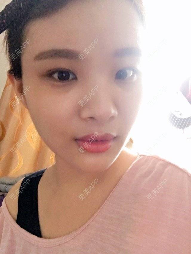 更美 - 照相机、的经验 | 注射美容 | 重庆 | 自体脂肪丰全面部 | 吸脂手术