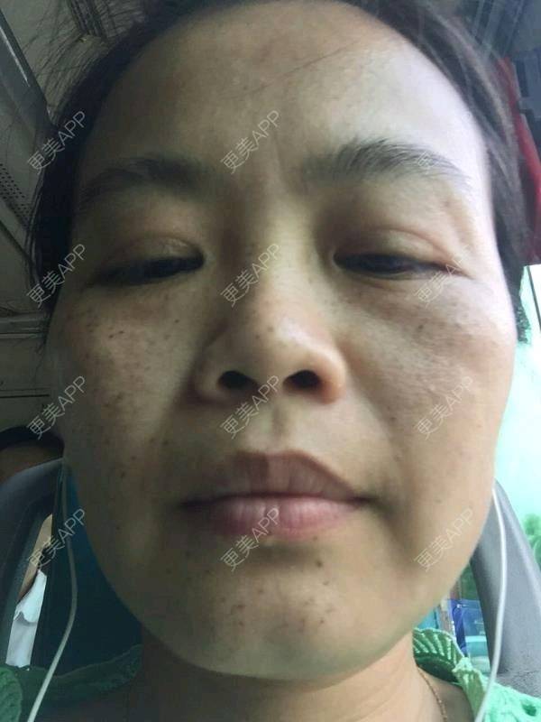 更美 - 木兰香kiss的激光点痣经验 | 去痣 | 祛斑祛色素 | 激光点痣 | 重庆