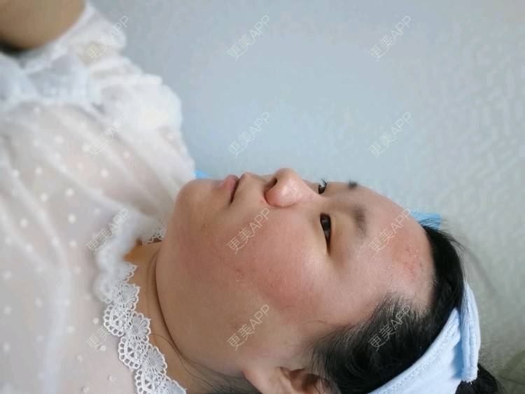 更美 - ✿西伯利亚的蝴蝶✿的小气泡经验 | 北京 | 小气泡 | 微针