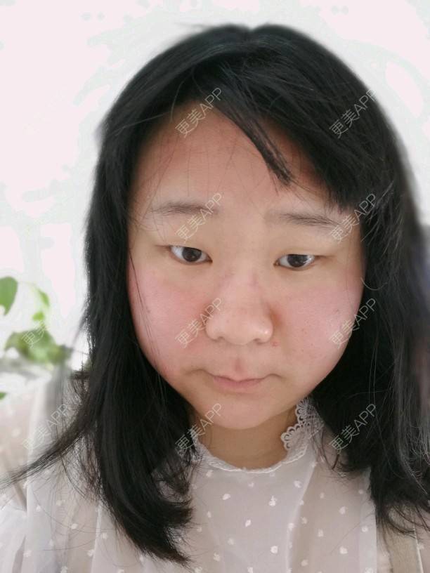更美 - ✿西伯利亚的蝴蝶✿的小气泡经验 | 北京 | 小气泡 | 微针