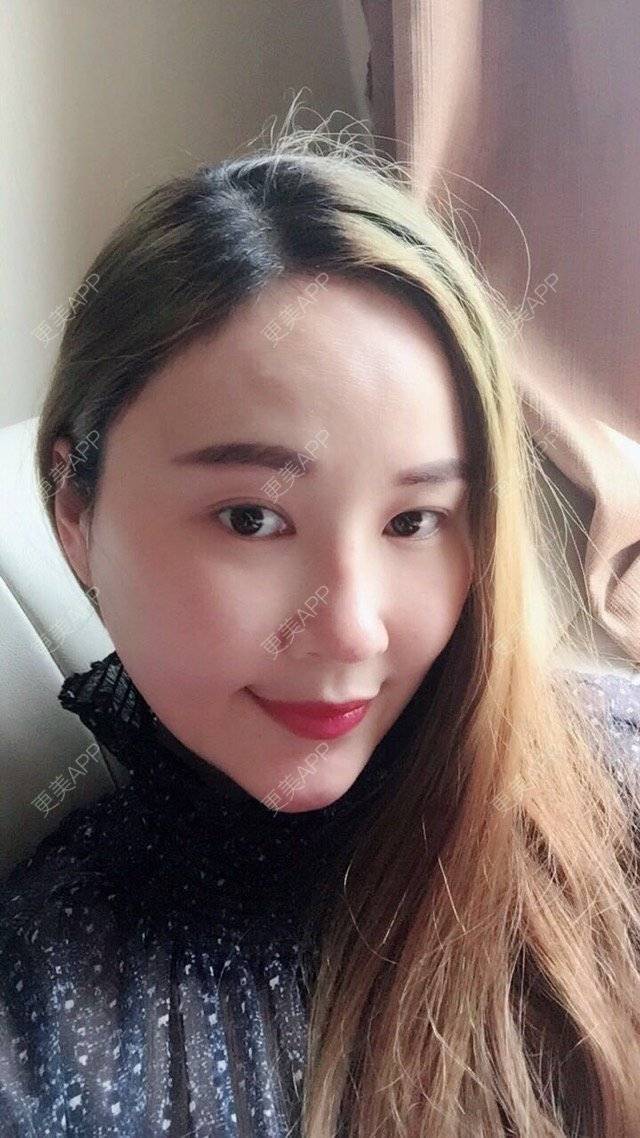 更美 - 三生花的隆鼻经验 | 成都 | 鼻部整形 | 隆鼻 | 歪鼻矫正手术