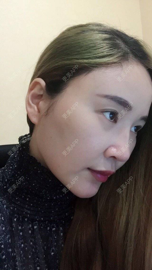 更美 - 三生花的隆鼻经验 | 成都 | 鼻部整形 | 隆鼻 | 歪鼻矫正手术