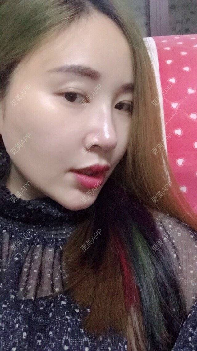更美 - 三生花的隆鼻经验 | 成都 | 鼻部整形 | 隆鼻 | 歪鼻矫正手术