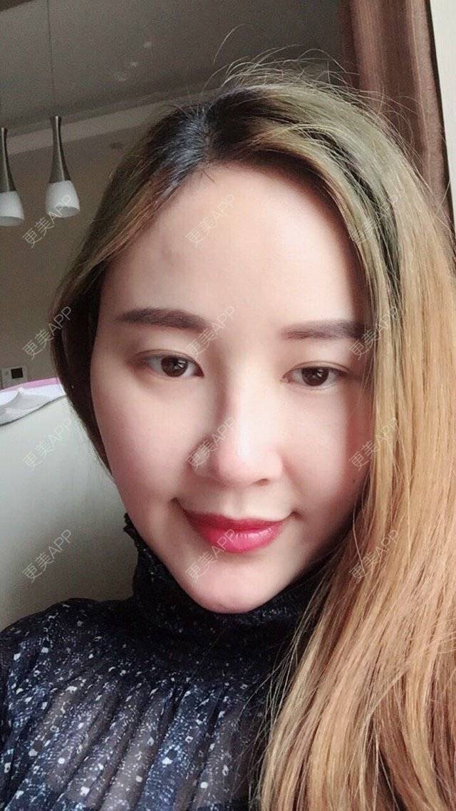 更美 - 三生花的隆鼻经验 | 成都 | 鼻部整形 | 隆鼻 | 歪鼻矫正手术