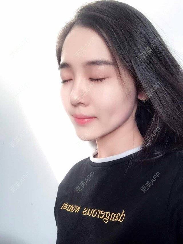 更美 - 绿野仙踪踪踪的全切双眼皮经验 | 除皱瘦脸 | 注射玻尿酸 | 全切双眼皮 | 深圳