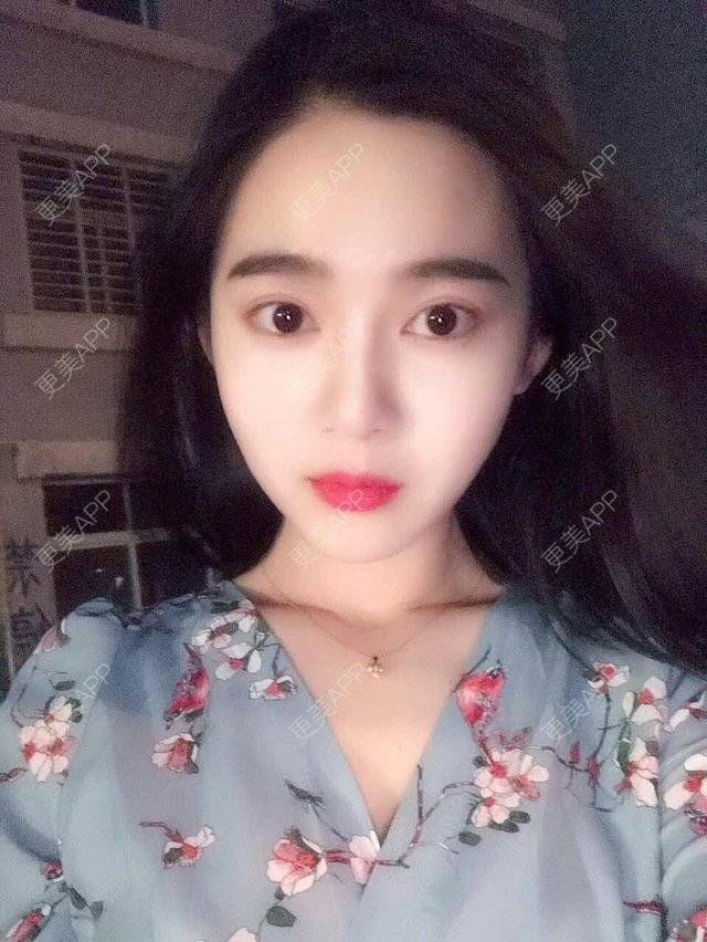 更美 - 绿野仙踪踪踪的全切双眼皮经验 | 除皱瘦脸 | 注射玻尿酸 | 全切双眼皮 | 深圳