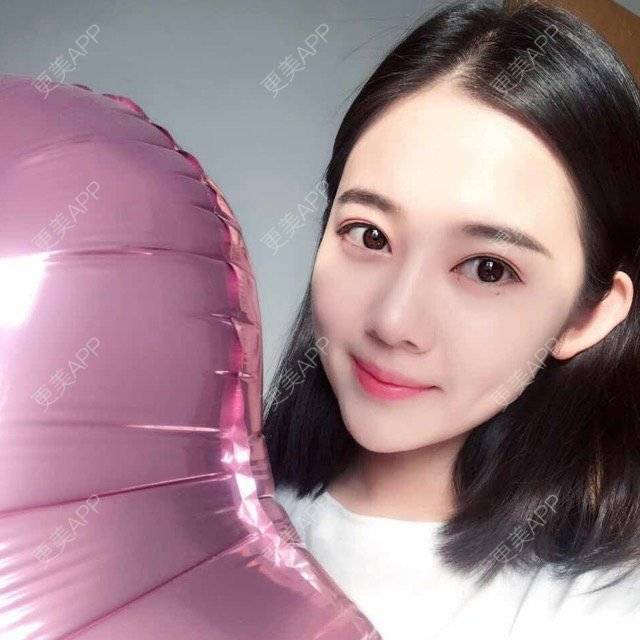 更美 - 绿野仙踪踪踪的全切双眼皮经验 | 除皱瘦脸 | 注射玻尿酸 | 全切双眼皮 | 深圳
