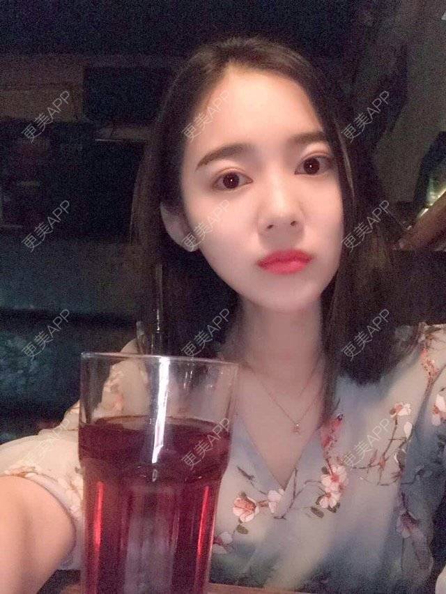 更美 - 绿野仙踪踪踪的全切双眼皮经验 | 除皱瘦脸 | 注射玻尿酸 | 全切双眼皮 | 深圳