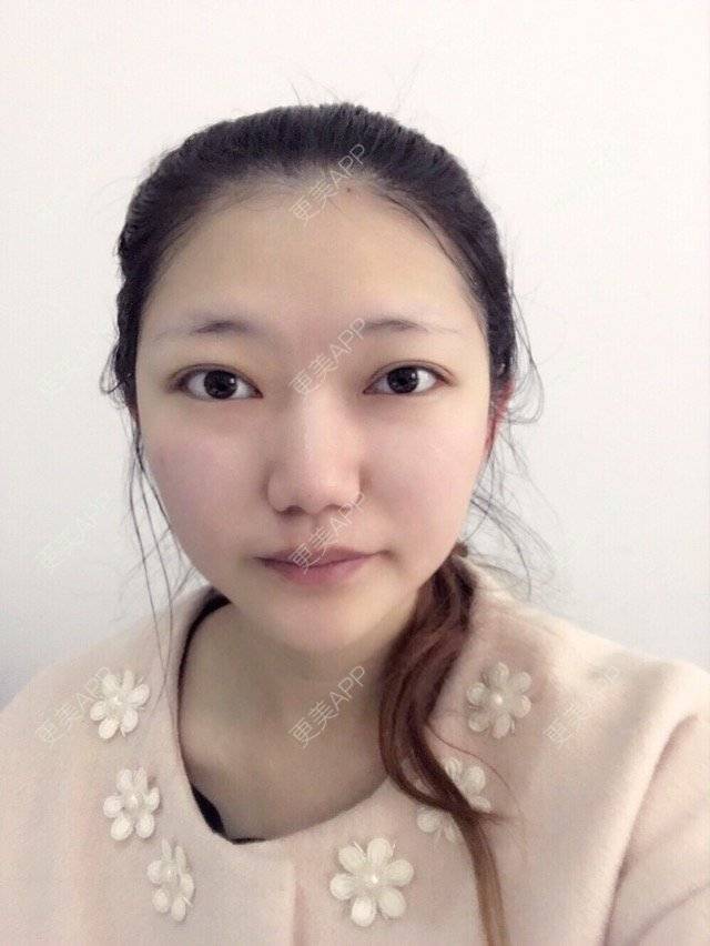 更美 - 嫣嫣妹妹的玻尿酸太阳穴经验 | 玻尿酸太阳穴 | 玻尿酸 | 武汉同城 | 武汉